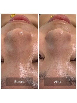 エヌ(enu)/毛穴洗浄/顔脱毛/炭酸ガスパック