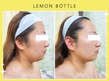 シロカネ 光の森店(SHIROKANE)/レモンボトル×小顔コルギ☆