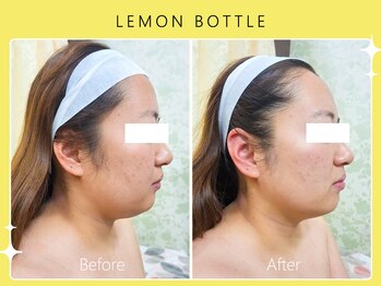 シロカネ 光の森店(SHIROKANE)/レモンボトル×小顔コルギ☆