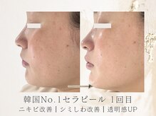 アネラボーテ(Anela Beaute)/シミシワ・跡が薄く！