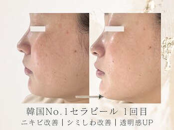 アネラボーテ(Anela Beaute)/シミシワ・跡が薄く！