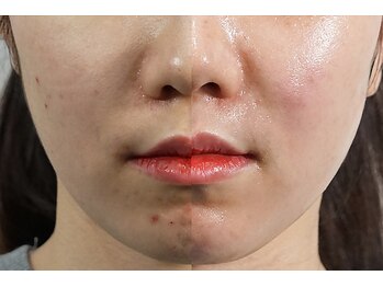 エターナル(Eternal)/ララピールでニキビ肌ケア