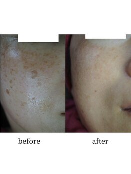 アップルミント/＜フェイシャル＞before・after