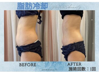 ユアーズビューティー(YOURS beauty)/脂肪冷却