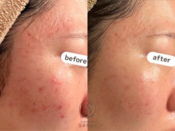 サンゴ(Sango)/ハーブ3回の経過/ニキビ/毛穴/凹