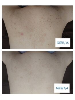 リブラン(Libran)/繰り返す背中ニキビに★