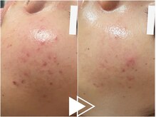 リシェス(Richesse)/プラズマニキビケア★初回¥9990