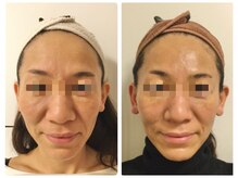 ビュー(Beau)/VOSトリートメント