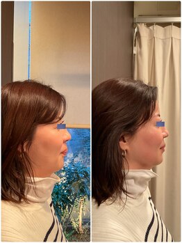 はる鍼灸整骨院/40代女性｜1回の結果