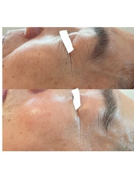 サクラ(SAKURA)/ビフォーアフター