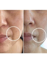 サロンドットブレスドットケイ(salon.bless.k)/たるみ緩和/シミ緩和/