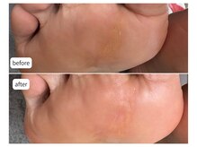 カシェット(Cachette)/40代女性◎足裏角質ケア90分