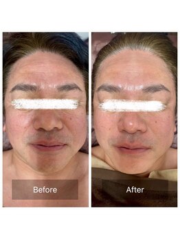 ラビ(RABBI)/50代男性　小顔矯正EMS 