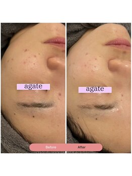 アガットバイミヤモト(agate by miyamoto)/施術３回　約1ヶ月半　2枚目