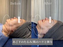 アイシス(AIsis)/【LDM/50代】たるみ/ハリ/弾力