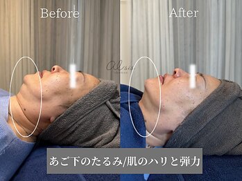 アイシス(AIsis)/【LDM/50代】たるみ/ハリ/弾力