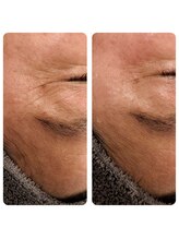 ティア(TIA)/メソスキン