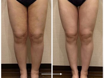 サロン タエン/術後インディバ