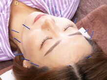 クシロ鍼灸整骨院/【美容鍼】鍼に電気は使いません