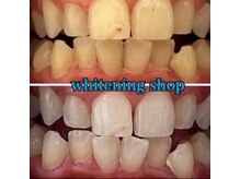 ホワイトニングショップ 長岡京店/ホワイトニングビフォーアフター