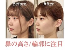 隆鼻矯正専門店 ラプリセレネ (Raplit Selene)/隆鼻+輪郭矯40分(小顔)10回