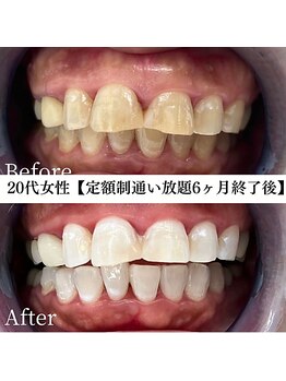 ホワイト 福岡博多店(WHITE)/ホワイトニングビフォーアフター