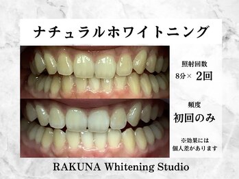 ラクナ(RAKUNA)/ナチュラルホワイトニング症例