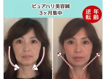 ピュアハリ/沖縄美容鍼/たるみ/効果