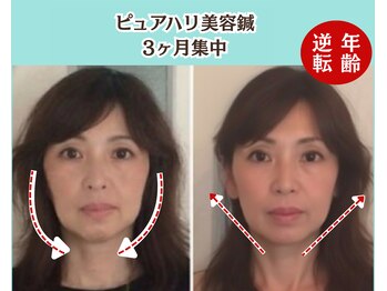 ピュアハリ/沖縄美容鍼/たるみ/効果