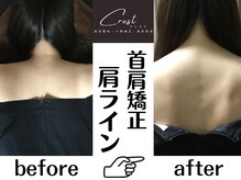 クレスト(CREST)/ビフォーアフター【首肩名古屋】