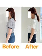 整体院ひなた 宮崎院/20代女性反り腰猫背改善3ヶ月