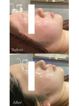 ダリアビューティー(Dahlia Beauty)/アンストレス before after