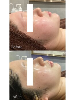 ダリアビューティー(Dahlia Beauty)/アンストレス before after