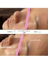 シュエット(Chouette)/ハーブピーリング一回の効果