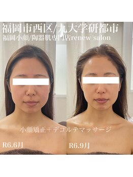 リニューサロン 本院(renew salon)/小顔矯正+デコルテマッサージ