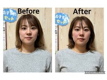 まごころ整骨院/美容鍼Before&After(１回施術）