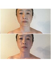 イデアール(Ideal)/ほうれい線薄く、リフトアップ