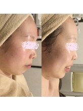 アユアランリンク 札幌店/20代後半/約2週間/赤み/横向き