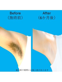 ブロッサム(BLOSSOM)/ワキ脱毛