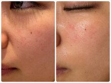 エイシスグロウ(asis glow.)/効果写真