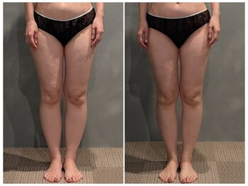 ツーアップ(2up)/下半身むくみ1回