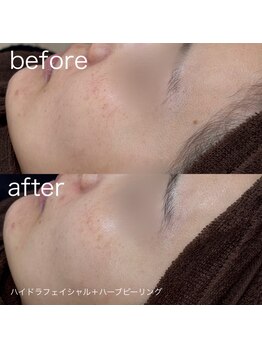 ルルラ リコ(lulula rico)/症例写真/ハーブピーリング