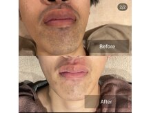 リエラ(Liella)の雰囲気（髭脱毛12回目効果◎別人レベルでトーンアップも叶う！）