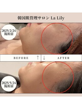 ラ リリー ステラ(La Lily stella)/韓国美肌!ニキビに悩む必要なし