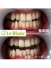 ルブラン 奈良店(Le Blanc)/犬歯まで白い歯に！