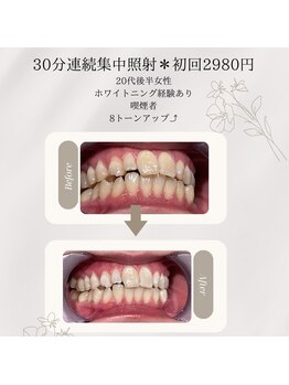 プラスビーセルフ(+b self)/ホワイトニングビフォーアフター