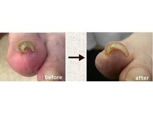 爪切り屋 足楽 日本橋三越前店/巻き爪３