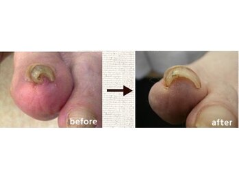 爪切り屋 足楽 日本橋三越前店/巻き爪3