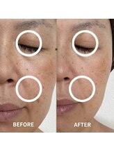 ビーンズ(BEANS)/LALAピール1回