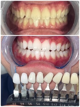 エクシア ホワイトニング 富山店/ビフォーアフター写真☆